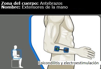 Epicondilitis y electroestimulación. Tratamiento y recuperación