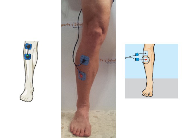 Periostitis Tibial anterior sobrecarga y electroestimulación