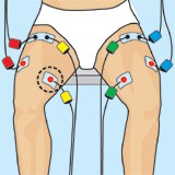 cintilla iliotibial lesion y tratamiento con electroestimulación