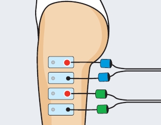 cintilla iliotibial dolor. colocacion de electrodos