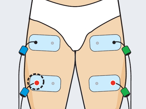 posicion electrodos cintilla iliotibial recuperacion