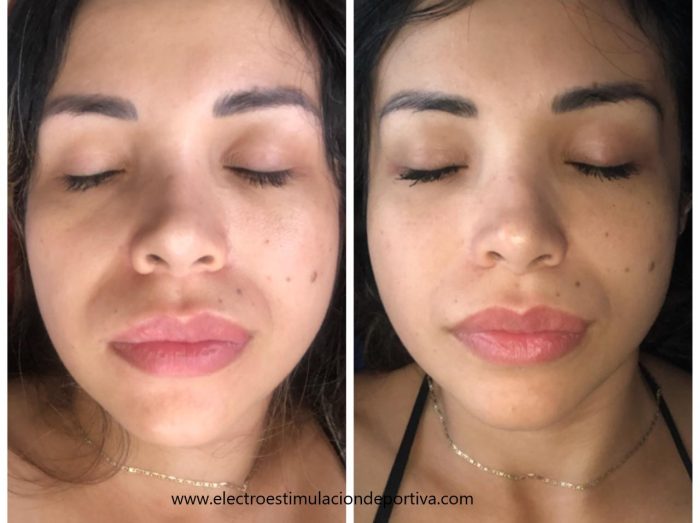 Resultados electroestimulación facial antes después  con globus activa 700. Microcorriente facial antes y  después