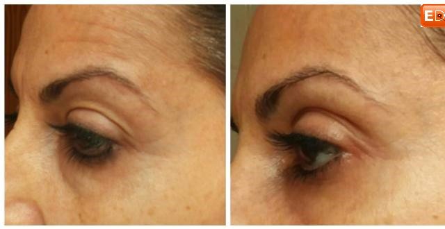 Efectos microcorriente facial. Resultados microcorriente globus activa 700