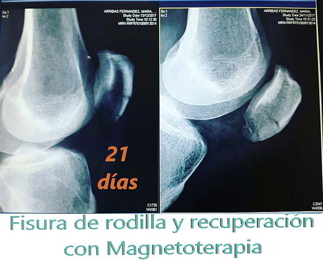 Magnetoterapia en rodilla, fisura de rótula. Fisura rodilla. Recuperación