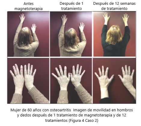 artritis reumatoide tratamiento con magnetoterapia