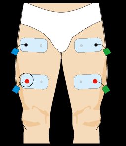 cuadriceps compex parches