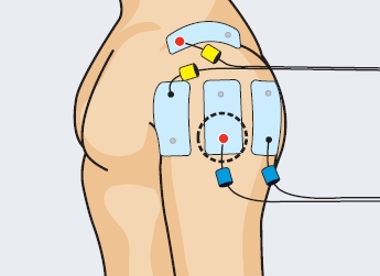 Electroestimulación para manguito rotador tratamiento Tendinitis hombro manguito rotador tratamiento electroestimulaicón