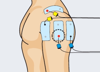 Tendinitis hombro manguito rotador tratamiento electroestimulaicón