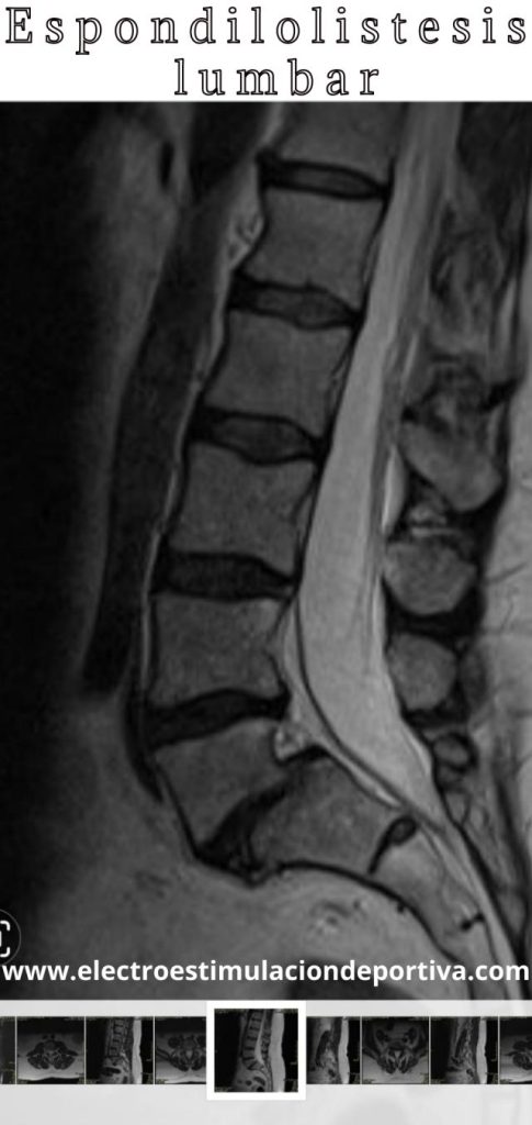 Tratamiento para la espondilolistesis lumbar con electroestimulación