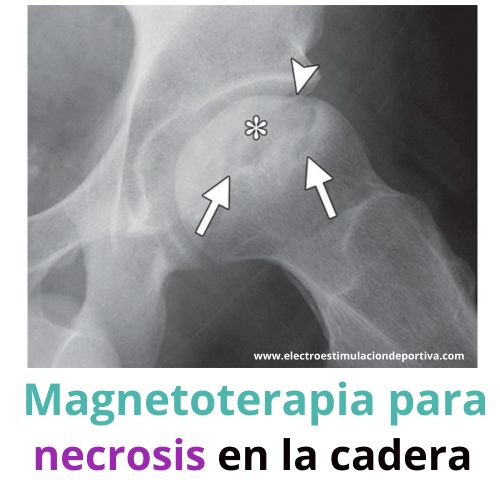 La necrosis de cadera tiene cura con magnetoterapia