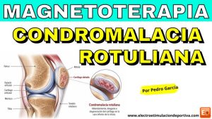 Condromalacia rotuliana: cómo puede ayudar la magnetoterapia