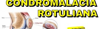 Condromalacia rotuliana: cómo puede ayudar la magnetoterapia