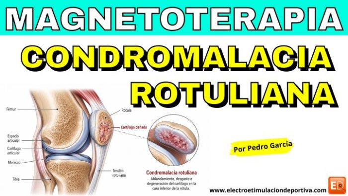 Condromalacia rotuliana: cómo puede ayudar la magnetoterapia