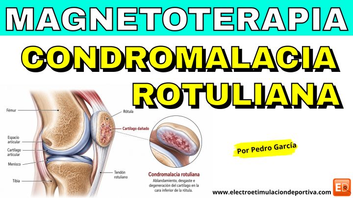 Condromalacia rotuliana: cómo puede ayudar la magnetoterapia