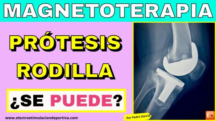 ¿Se puede usar magnetoterapia con una prótesis de rodilla?