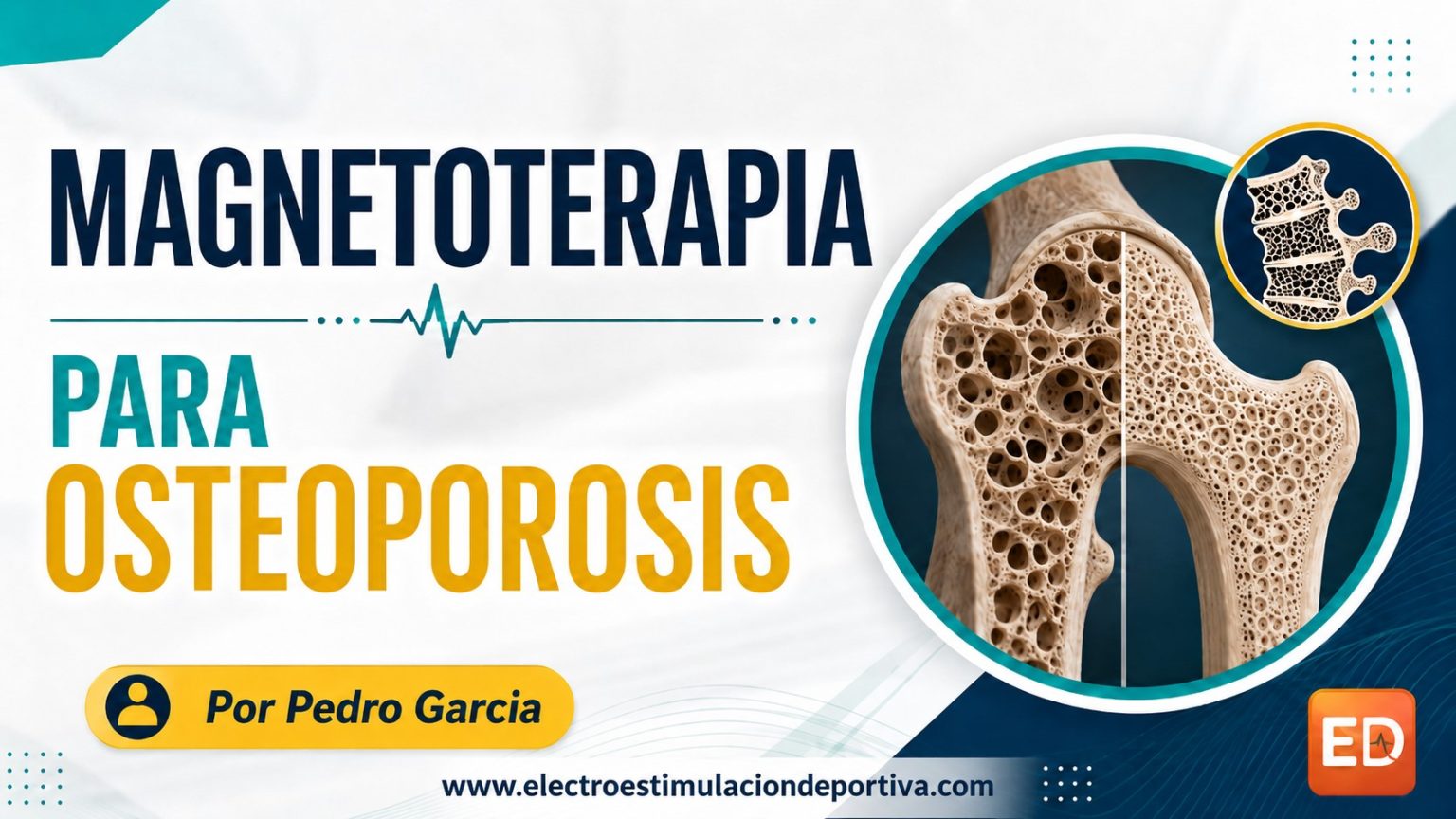 ¿Sirve la magnetoterapia para osteoporosis?